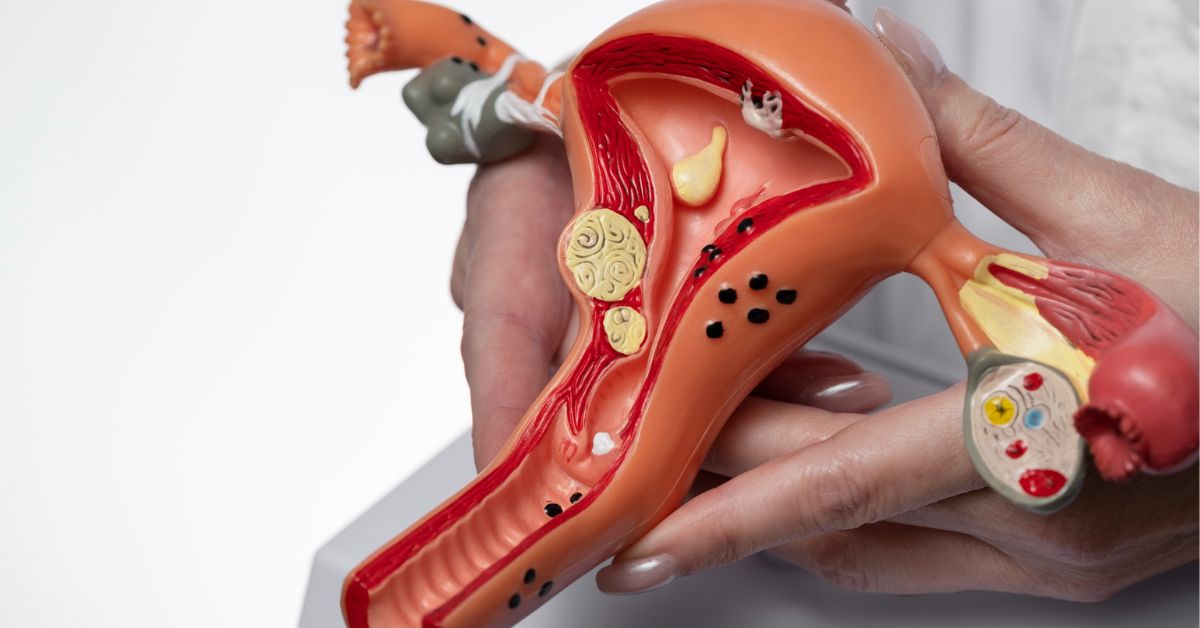 fibroid surgery in indore