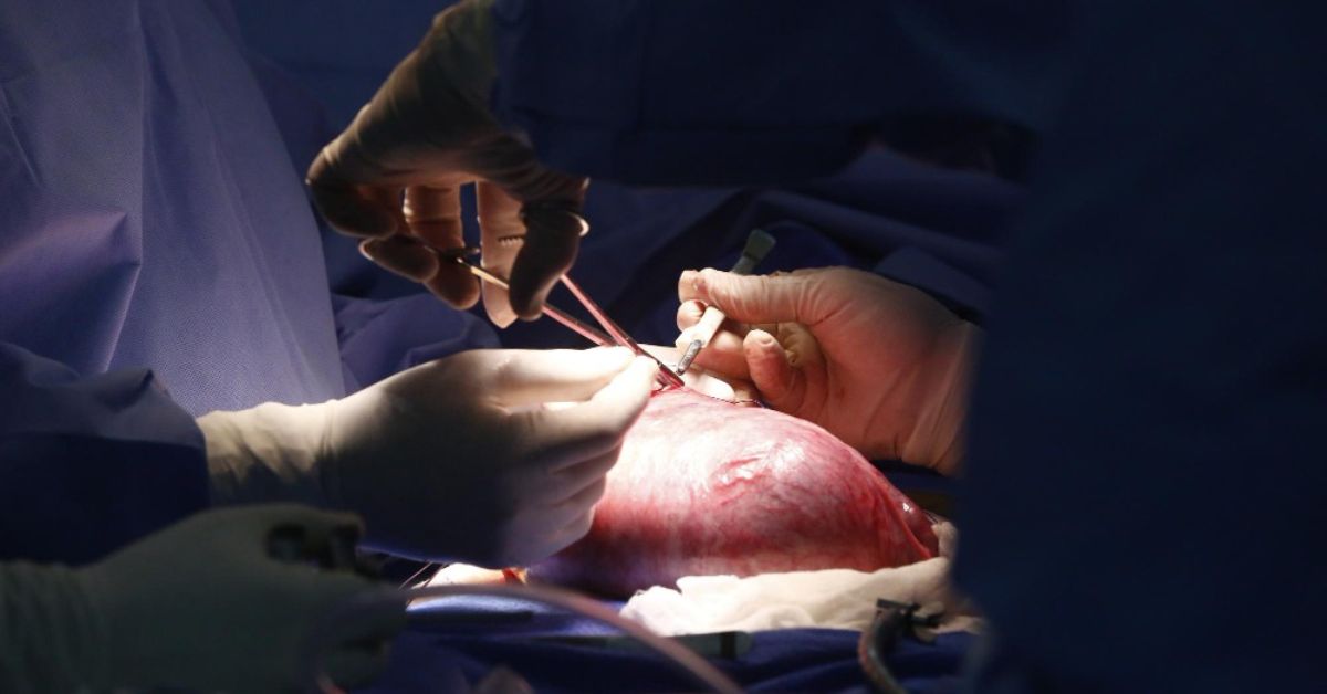 fibroid surgery doctor in indore